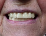 horní snímatelná náhrada s keramickými zuby